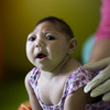 Microcephaly