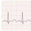 Tachycardia