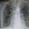 Pulmonary fibrosis