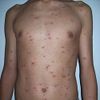 Chickenpox