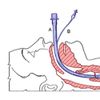 Mechanical ventilation