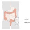 Colostomy