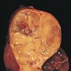 Thymoma