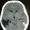 Brain injury