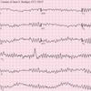 Ventricular fibrillation