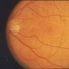 Retinopathy