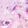Arteriovenous malformation