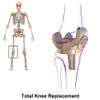 Knee replacement