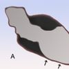 Takotsubo cardiomyopathy