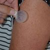 Transdermal