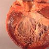 Cardiomyopathy